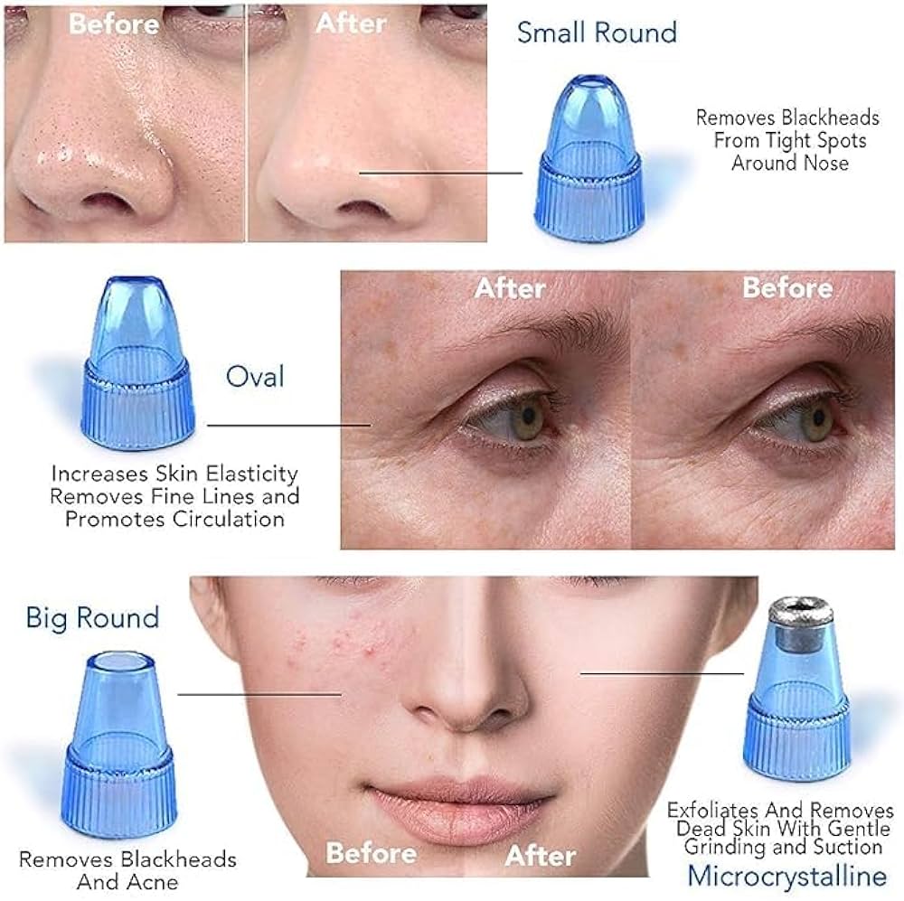 4-in-1 Blackhead Remover Vacuum for Women & Men – Electric Pore Cleaner with 4 Suction Heads, USB Rechargeable Acne Extractor