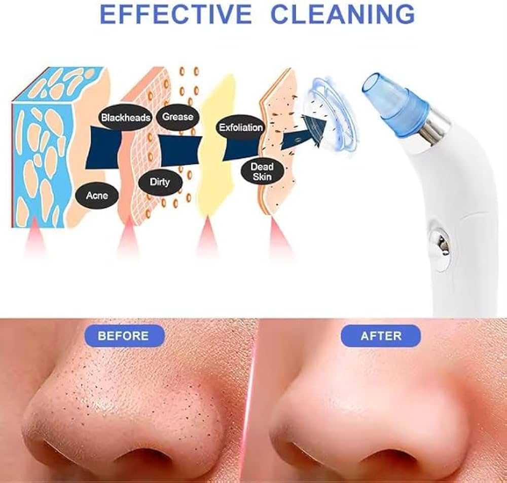 4-in-1 Blackhead Remover Vacuum for Women & Men – Electric Pore Cleaner with 4 Suction Heads, USB Rechargeable Acne Extractor